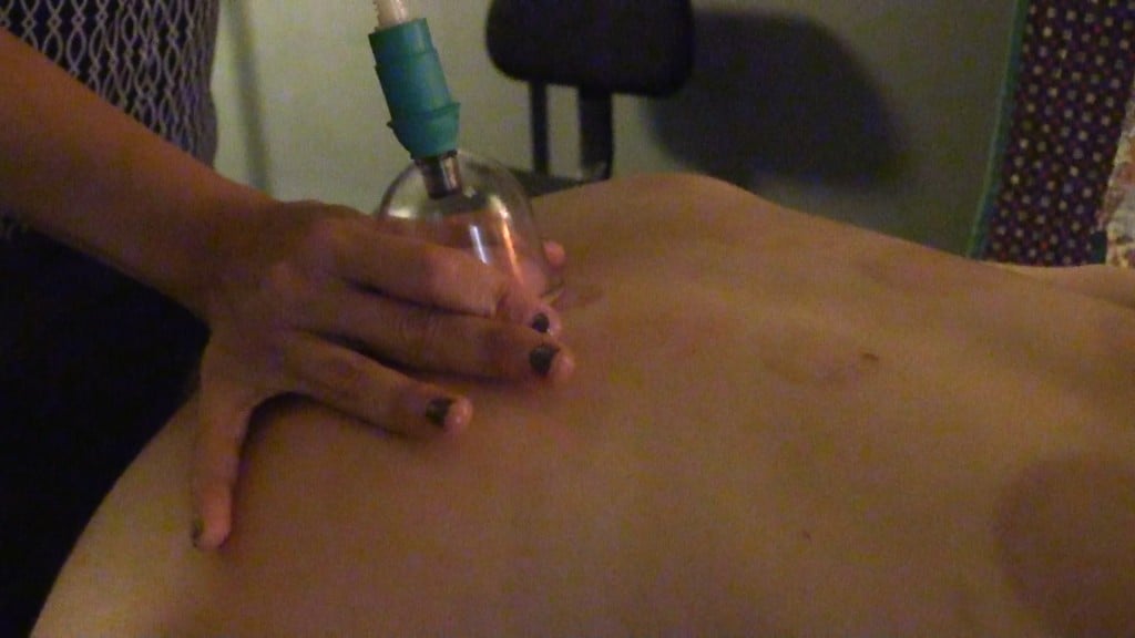 Cupping