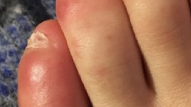 red-swollen-toes-it-could-be-covid-19-abc6