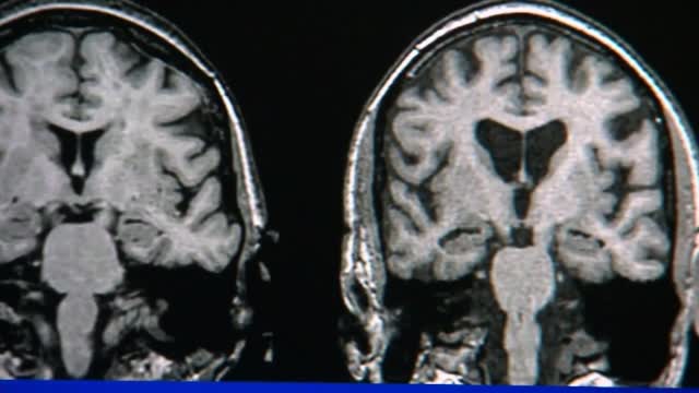 New Fda Approved Drug