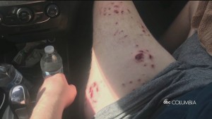 Nc Teen Shark Attack