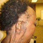 Victim 3 Burn Injuries