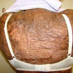Victim 4 Burn Injuries