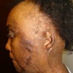 Victim 2 Burn Injuries