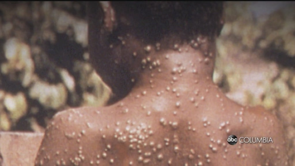Monkeypox