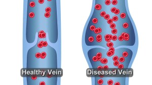 Midlands Cares: Vein Concerns