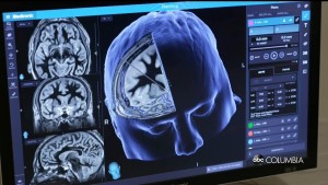 16 Million People Are Living With Cognitive Impairment In The Us