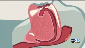 Health Minute: Snoring Possibly A Sign Of More Dangerous Sleep Condition