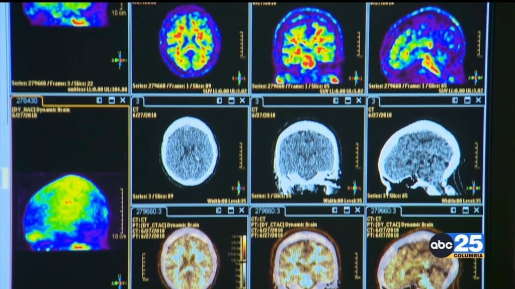 Alzheimer's Association Pushes For Federal Research Center In Sc, Lawmakers Introduce Bill To Update Alzheimer's Plan