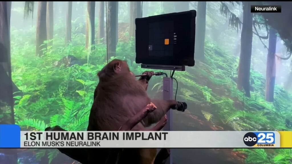 1st Human Brain Implant