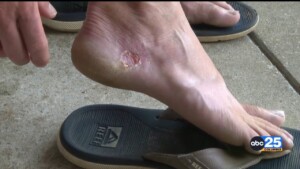 Flesh Eating Bacteria