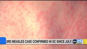 Sc's 3rd Measles Case Confirmed As Vaccines Face Polarizing Views By U.s. Health Officials