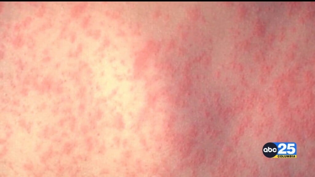 Scdph Updates Public On Confirmed Measles Outbreak