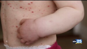 Scdph Increases South Carolina Measles Case Count