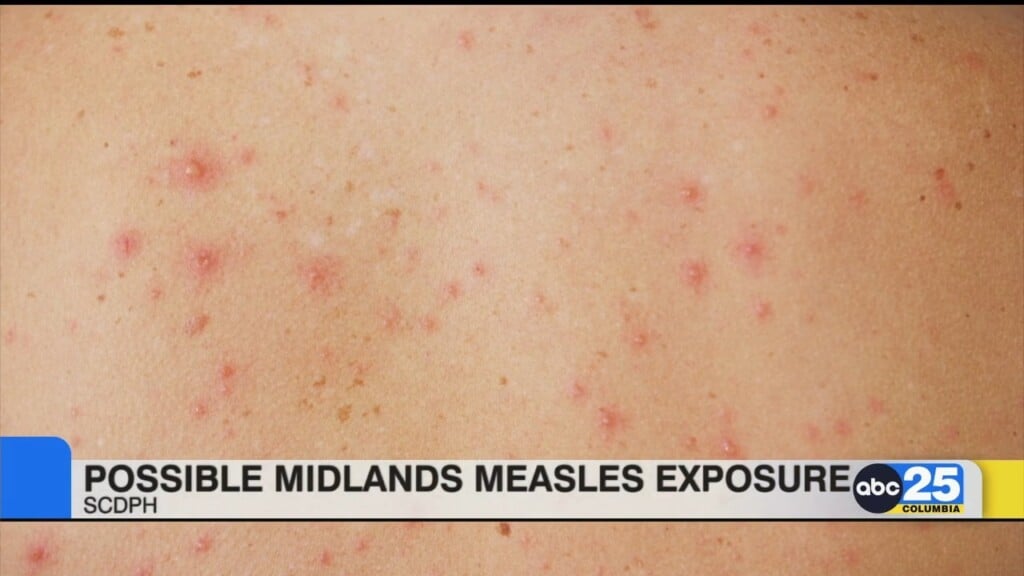 Possible Midlands Measles Exposure