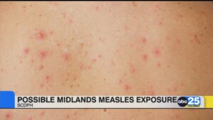 Possible Midlands Measles Exposure