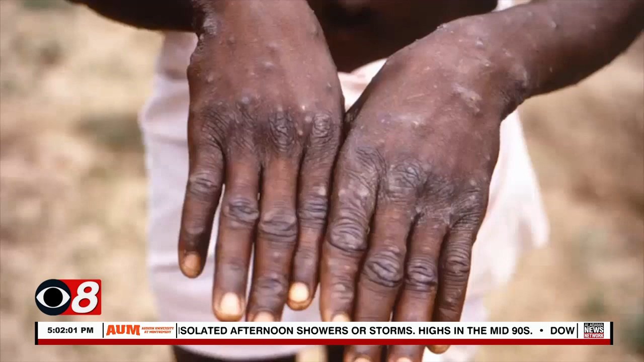 The State of Alabama Has Monkeypox Vaccinations - Alabama News