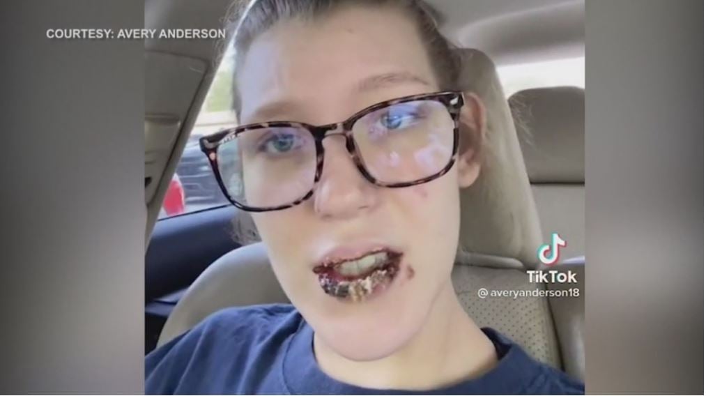 COVID and acne medication turned a woman's lips black.