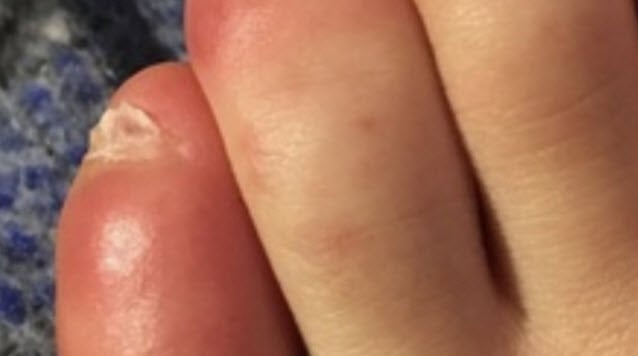 Red Swollen Toes