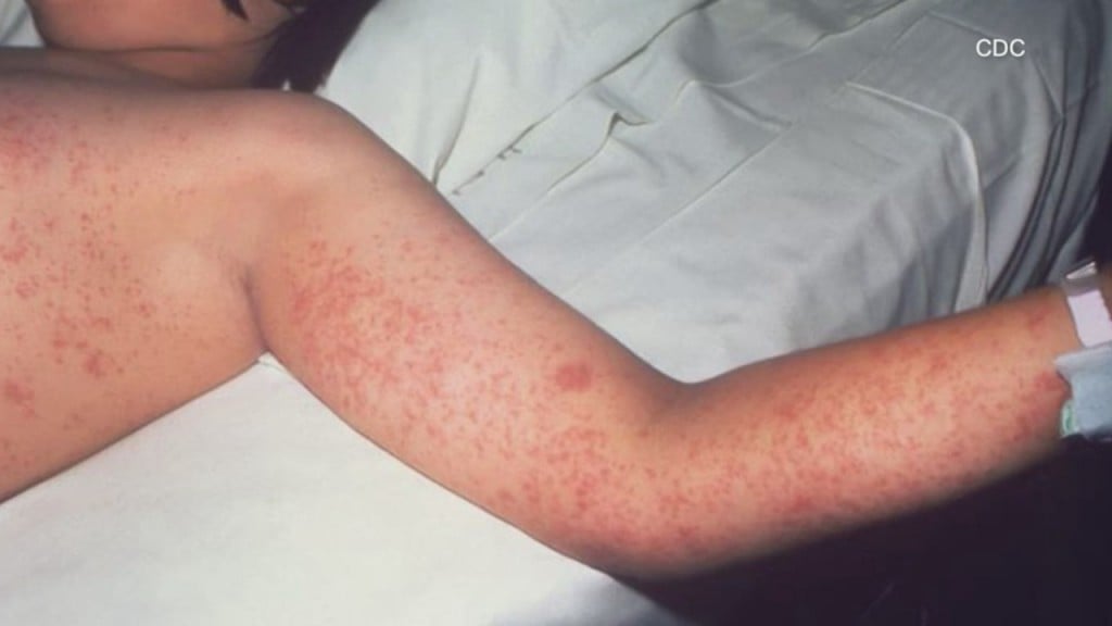 Vaccine Hesitancy Creates Concern About Measles Resurgence