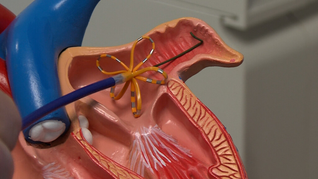Afib
