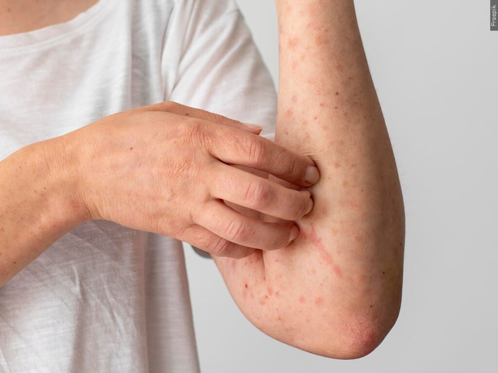 Measles rash