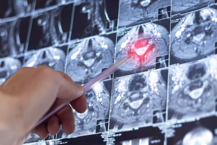 Doctor,examining,mri,neck,spine.,x Ray,scan.,spondylosis,of,the