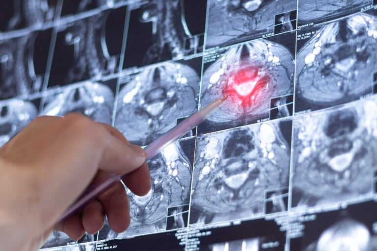 Doctor,examining,mri,neck,spine.,x Ray,scan.,spondylosis,of,the