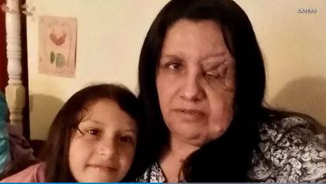 Mom with facial tumors says her daughter is being bullied because of them