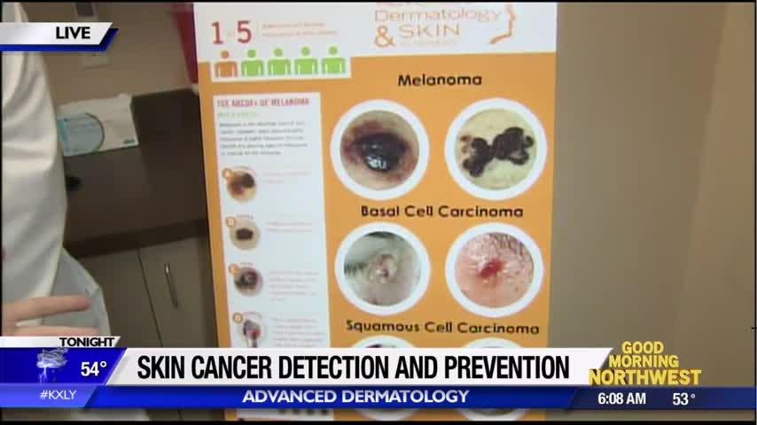 Spotting skin cancer and preventing it