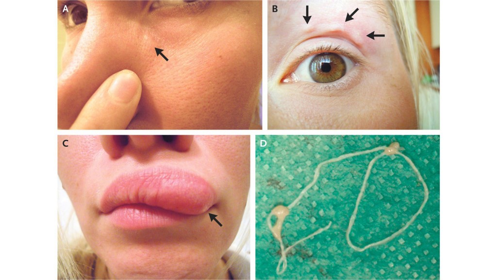 Moving lump on woman’s face turns out to be parasitic worm