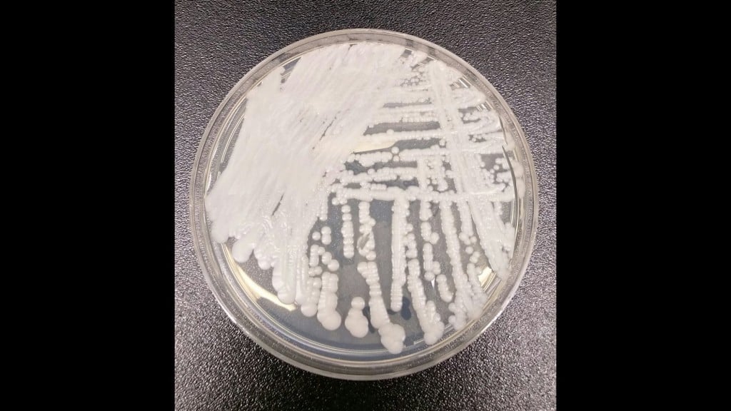 This drug-resistant fungus is spreading
