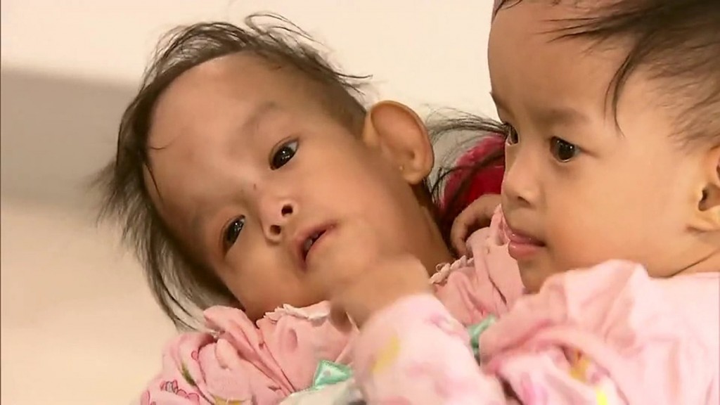 Conjoined Bhutanese twins separated after 6-hour surgery
