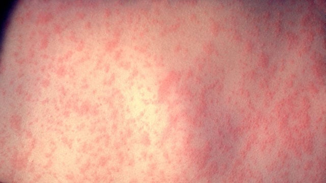 Measles alert issued for Chicago’s O’Hare airport