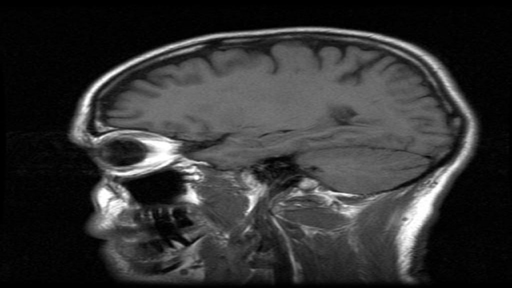 Number, severity of brain injuries raises dementia risk