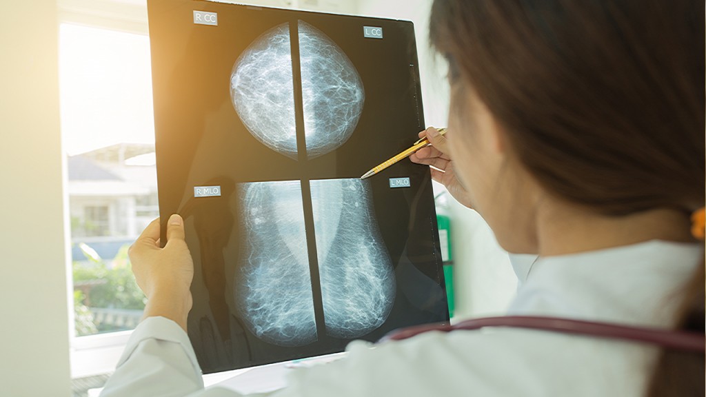 3 reasons you need a 3D mammogram