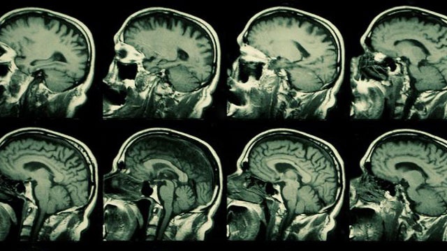 Mild traumatic brain injury linked to higher risk of PTSD, depression