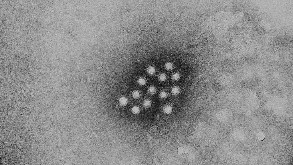Hepatitis A outbreak cases on rise
