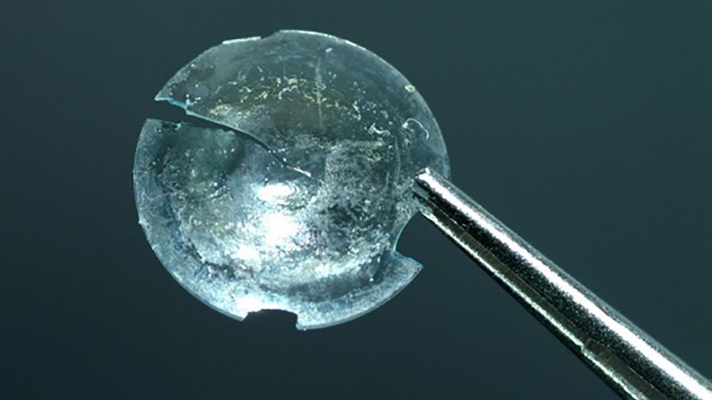 Contact lens embedded in woman’s eyelid for 28 years