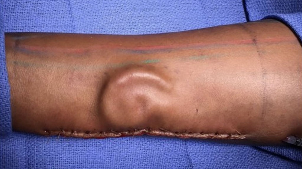 A soldier lost her ear in a car accident. So the doctors grew her a new one — in her forearm