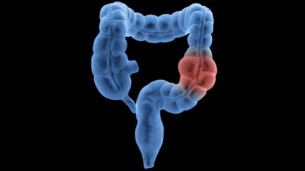 Medical groups differ on when to start colon, rectal cancer screening
