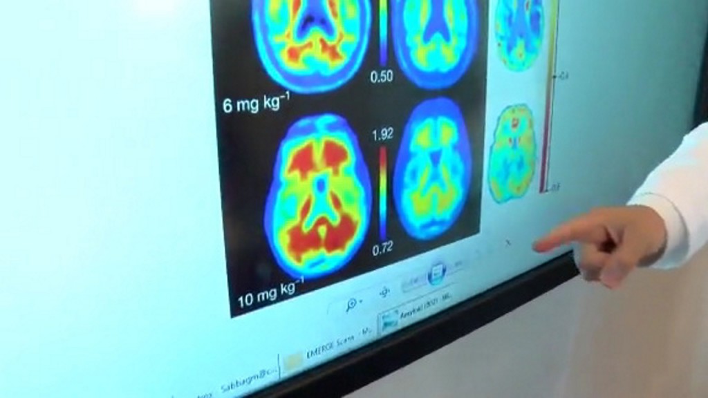 Alzheimers drug shows promise