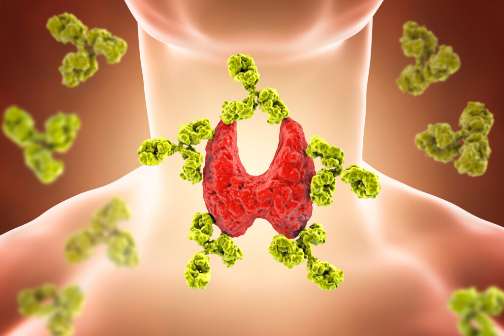 Autoimmune Thyroiditis, Hashimoto's Disease