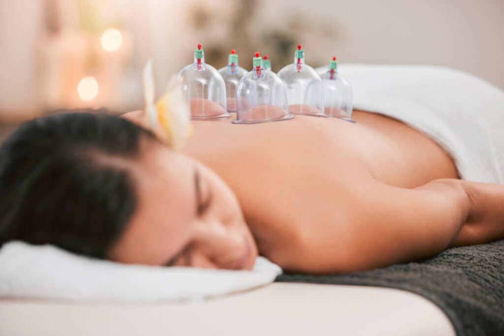 Spa, Physiotherapy Or Cupping Therapy Woman For Massage, Back Pain Or Luxury Wellness Medical Help. Asian Medicine, Health Or Relax Girl For Zen, Spiritual Or Stress Healing Therapy With Vacuum Cups