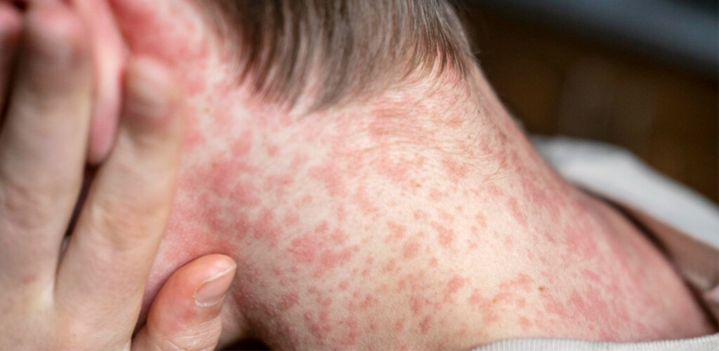 0measles Header