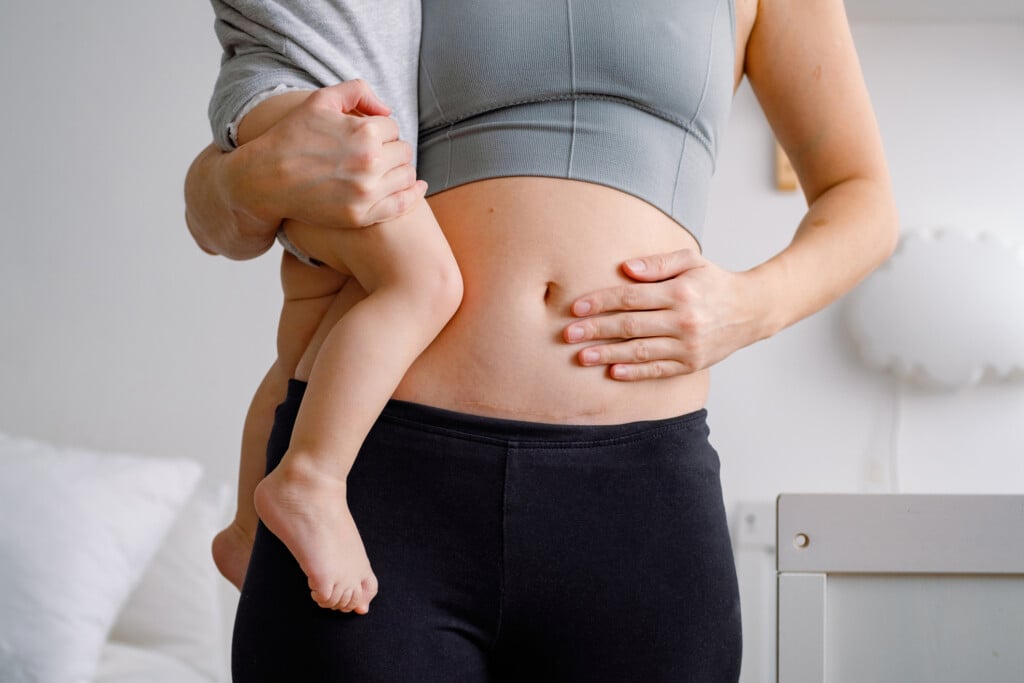 a woman with a c-section scar holding her baby