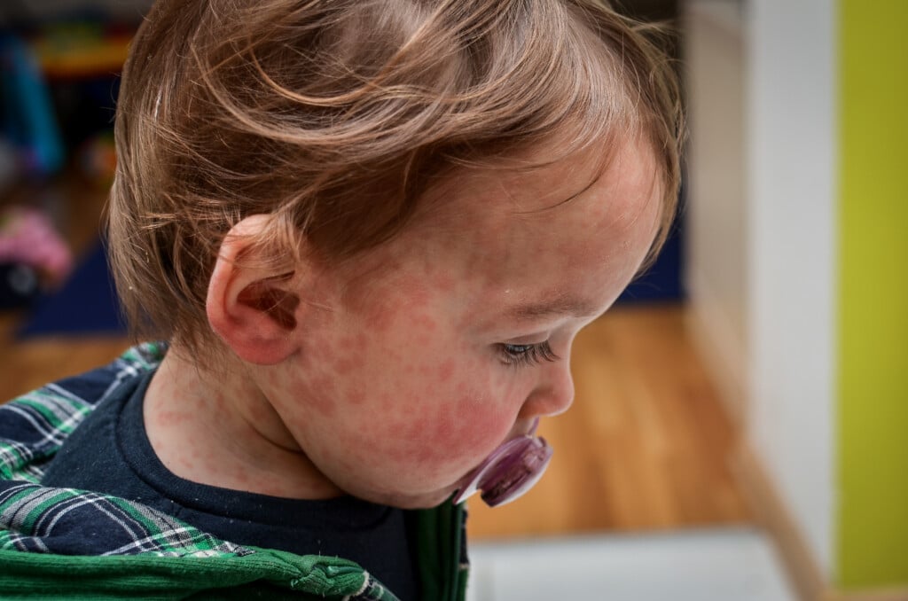 young child with a measles like rash