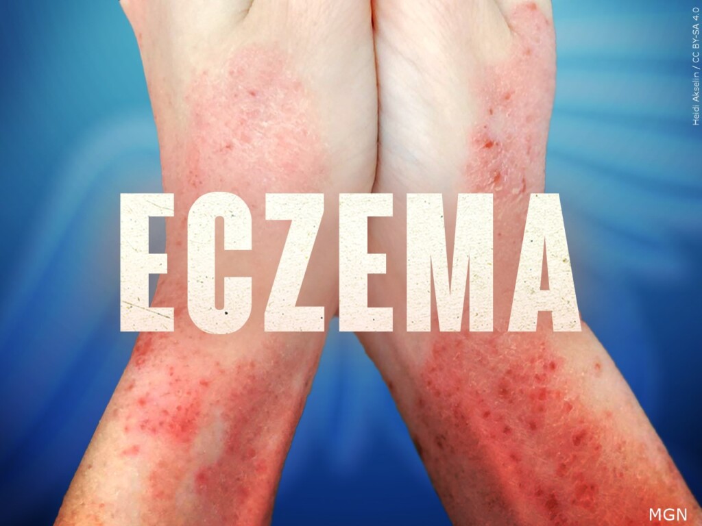 eczema