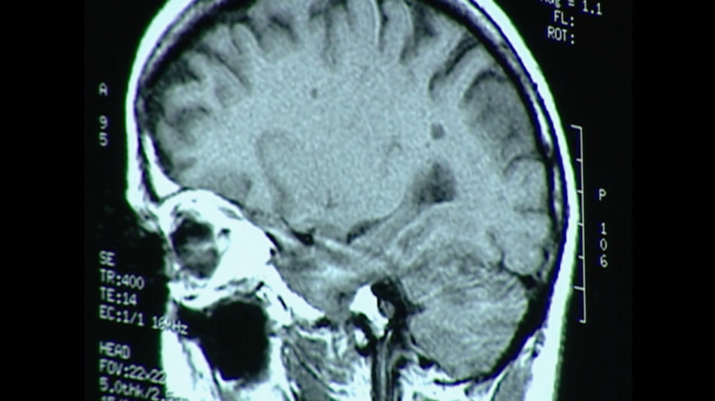chronic disease