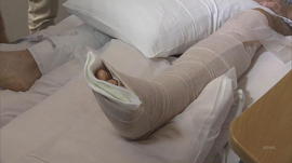 ctm-0523-hawaii-volcano-injury-darryl-clinton-leg.jpg 