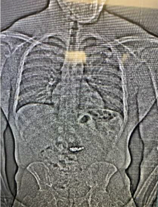 An x-ray shows what are believed to be two diamond earrings that were stolen from a Tiffany & Co. jewelry store in central Florida and were swallowed by a suspect. ( Orlando Police Department office via AP)